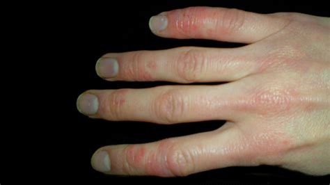 Systemic Sclerosis (Scleroderma):Picutres, Symptoms, Causes