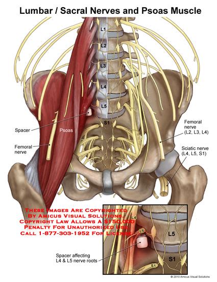 Lumbar/Sacral Nerves and Psoas Muscle