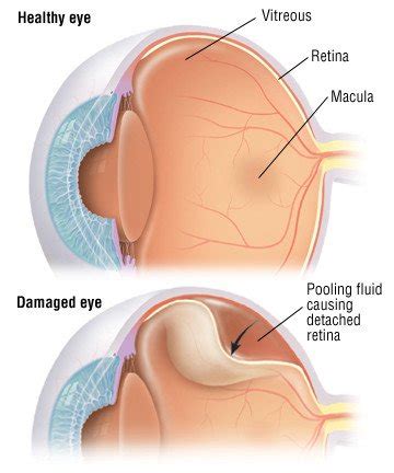 Detached Retina Guide: Causes, Symptoms and Treatment Options