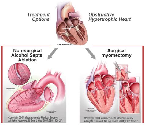 Hypertrophic Cardiomyopathy Treatment — School of Medicine University of Louisville