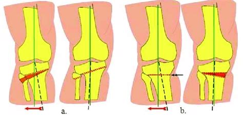 High Tibial Osteotomy (HTO) Surgery | Dr. Patrick Chin Orthopedic ...