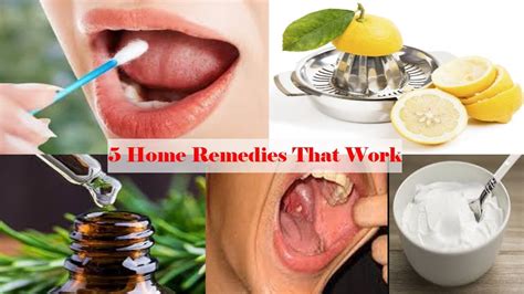 How Do You Remove Tonsil Stones At Home - 5 Home Remedies That Work - YouTube