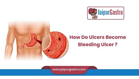 How Do Ulcers Become Bleeding Ulcer - Is it possible to prevent [2022]