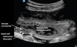 Bowel oedema – Critical Care Sonography