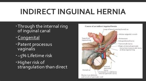 Inguinal hernia