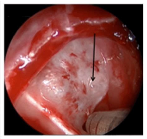 Intraoperative endoscopic view of right sphenoid sinus with... | Download Scientific Diagram