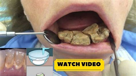 Remove Teeth Plaque and tartar At Home Naturally fast and easily | how ...