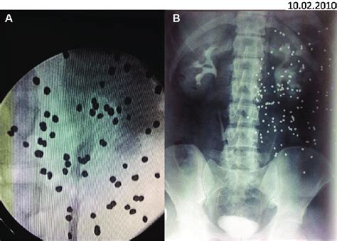 (A) Retrograde pyelogram demonstrating 1.5 cm long stricture; (B ...