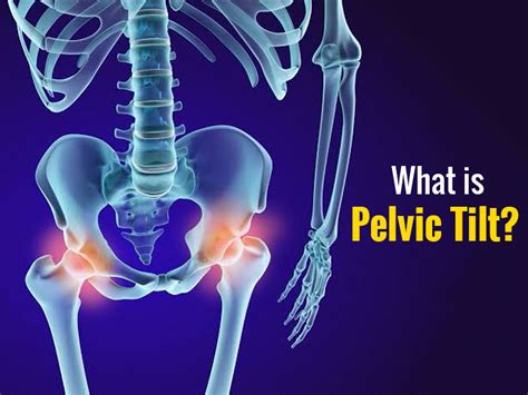 What Is Anterior Pelvic Tilt And How Can You Fix It? | OnlyMyHealth