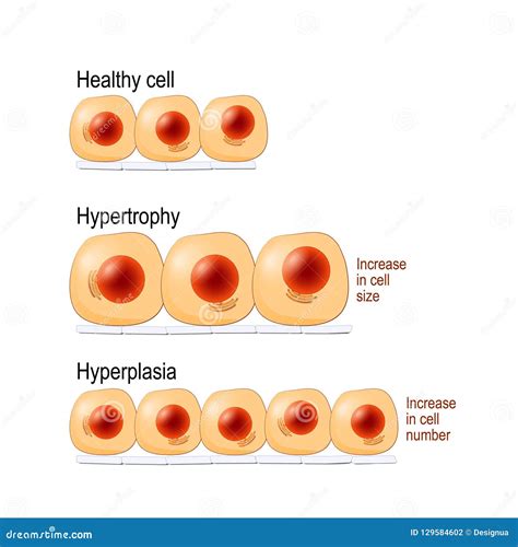 Hyperplasia: Definition, Pathological Hyperplasia, Physiologic ...