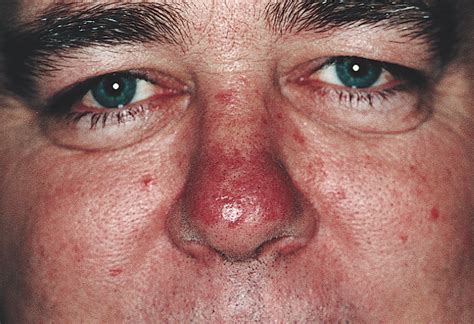 Treatment of Granuloma Faciale With the 585-nm Pulsed Dye Laser | Surgery | JAMA Dermatology ...