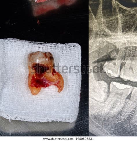 Extracted Tooth Xray Before Extraction Stock Photo 1960803631 | Shutterstock