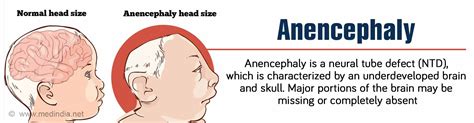 Anencephaly - Causes, Symptoms, Diagnosis and Treatment