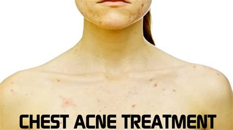 How To Get Rid Of Chest Acne - Be Your Best, Well, Self