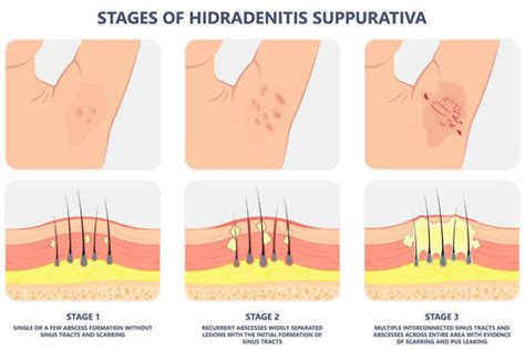 What is hidradenitis suppurativa and how to treat it – Dermeleve®