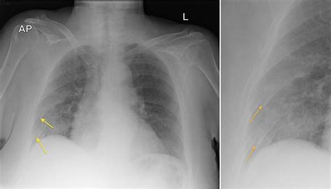 Rib Fractures - Radiology at St. Vincent's University Hospital