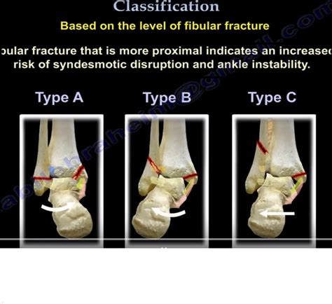 Danis Weber Classification of Ankle fractures — OrthopaedicPrinciples.com