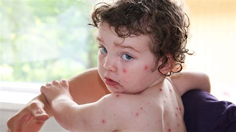 Chickenpox in children and teenagers | Raising Children Network