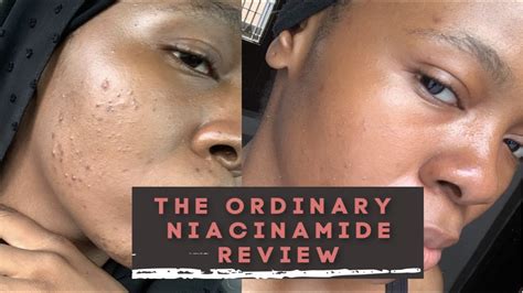 THE ORDINARY NIACINAMIDE 10% + ZINC 1% REVIEW, HOW I REACTED TO IT WITH ...