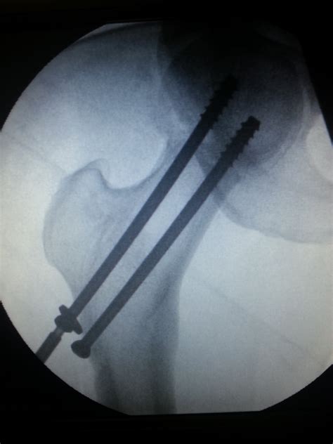 Femur Bone Fracture Surgery