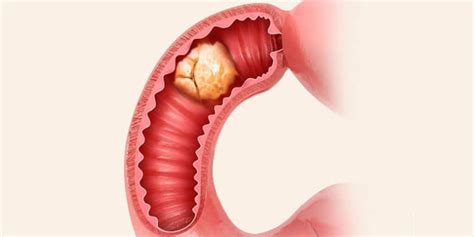 Colon Cancer Surgey Texas: Dr. Valeria Simone MD