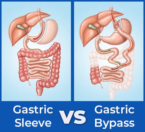 Gastric Sleeve vs Gastric Bypass: Choosing the Right Bariatric Surgery