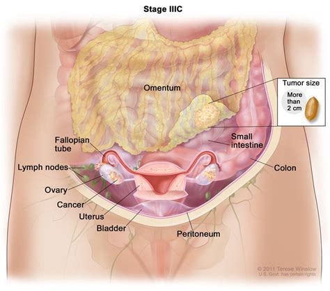 Ovarian Epithelial, Fallopian, & Peritoneal Cancer Treatment (PDQ®) - NCI