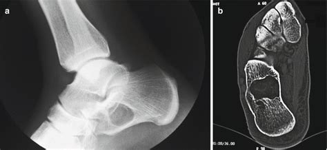 Simple Bone Cyst | Musculoskeletal Key