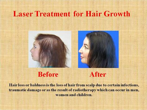 Laser Treatment for Hair Growth by hairlaser on DeviantArt