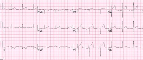 Dr. Smith's ECG Blog: Why we need continuous 12-lead ST segment ...