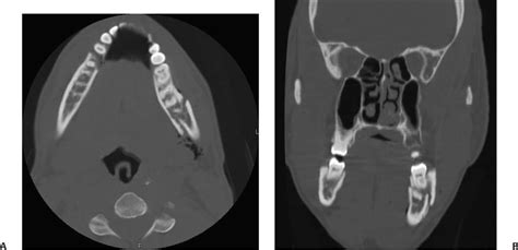 Mandibular Fracture | Ento Key