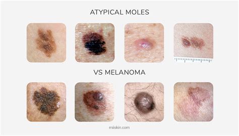 Atypical Moles Guide | Definitions, Pictures and Risks