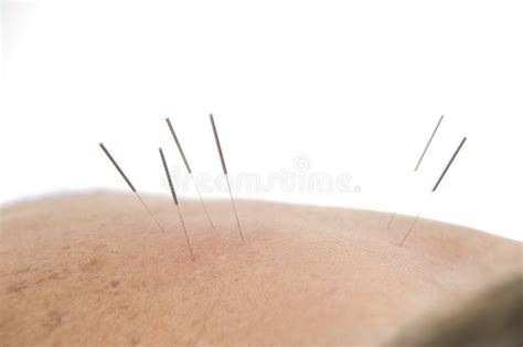 Acupuncture Needles in Backs Stock Photo - Image of massage, column: 12580356