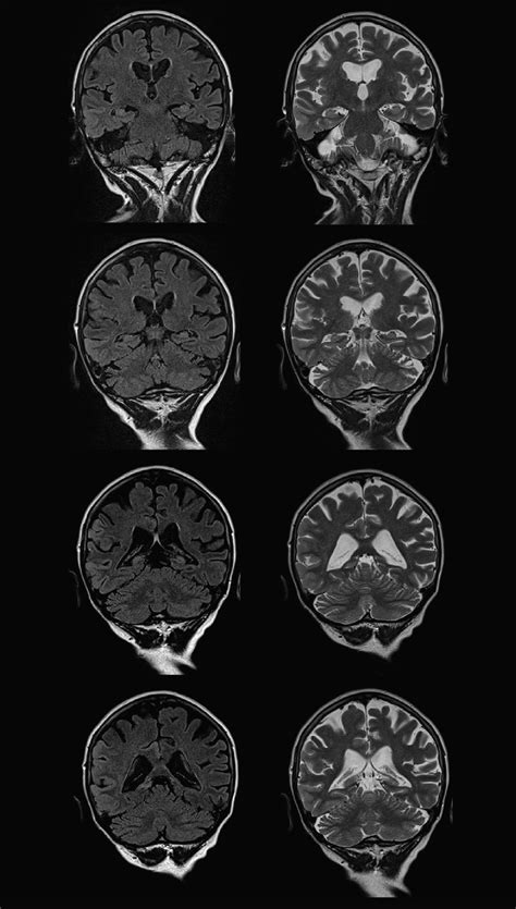 Brain MRI shows increased cortical thickness and FLAIR/T2 hyperintense ...