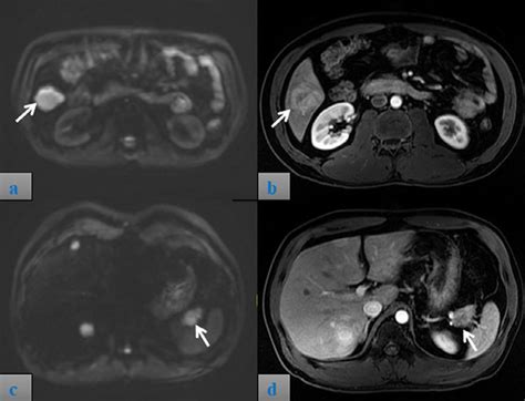 -Magnetic resonance imaging (MRI). (A) Diffusion-weighted imaging (DWI ...