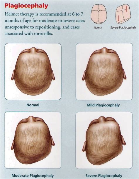 Plagiocephaly