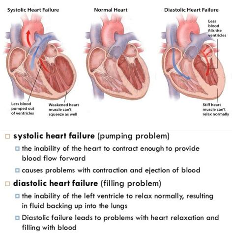 Systolic VS Diastolic Heart Failure | Diastolic heart failure, Heart failure nursing, Heart failure