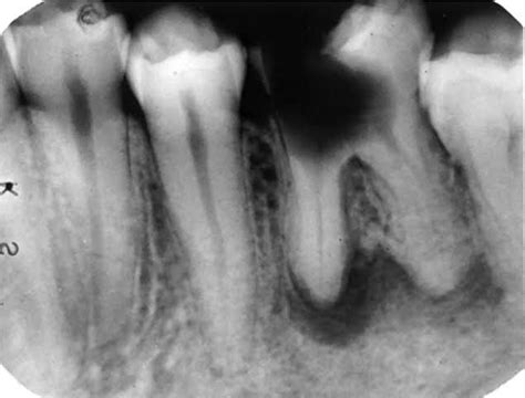 Periapical granuloma - MEDizzy