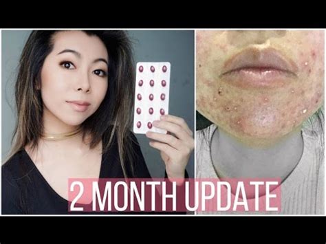 2 Month Accutane Update \ Side Effects - YouTube