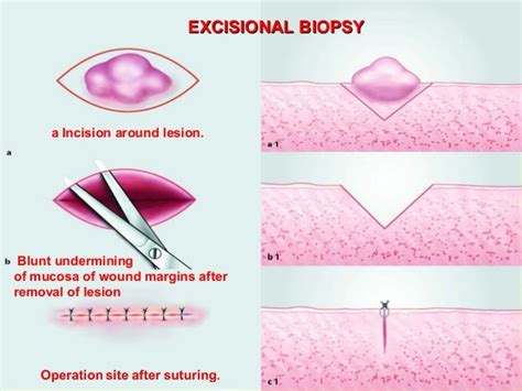 Biopsy