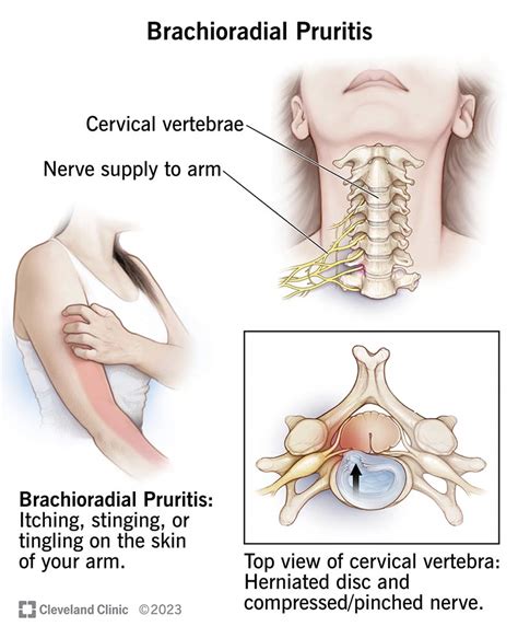 Brachioradial Pruritus: Causes, Symptoms & Treatment