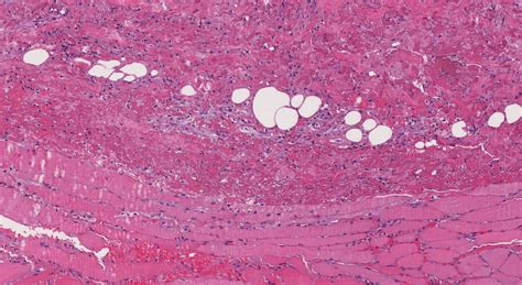 Necrotizing fasciitis | Atlas of Pathology