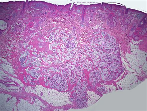 Mucinous Carcinoma - Dermatology Advisor