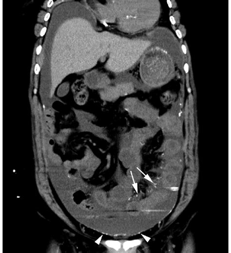 Hypertensive nephropathy led to chronic kidney failure in a 69-year-old... | Download Scientific ...