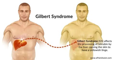 Gilbert Syndrome: Causes, Symptoms, Diagnosis and Treatment | Healthtian