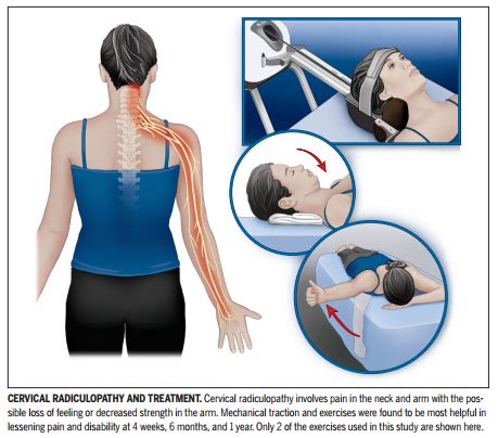 Pin on Cervical Radiculopathy