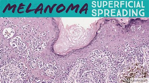 Superficial Spreading Malignant Melanoma