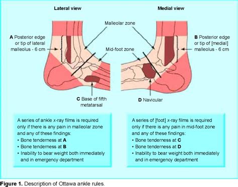 [PDF] Implementation of the Ottawa ankle rules by general practitioners ...