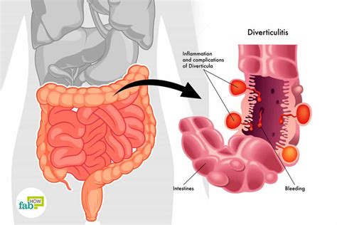 How to Treat Diverticulitis: 8 Home Remedies for Relief | Fab How