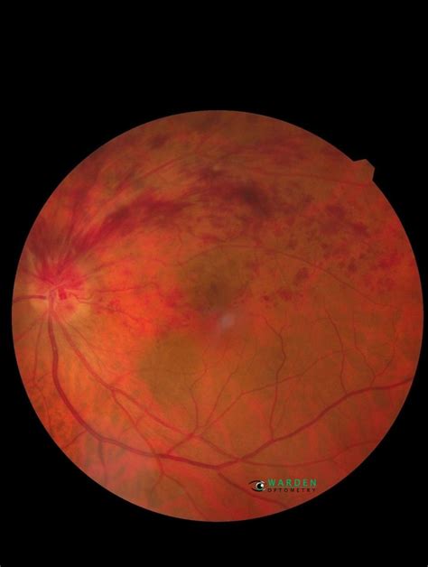 What's an ocular stroke? in 2021 | Ocular, Eye health, Vision loss